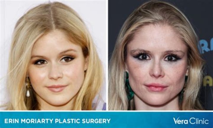 
Untold Truth On Erin Moriarty Plastic Surgery, Before and After Face Photos 